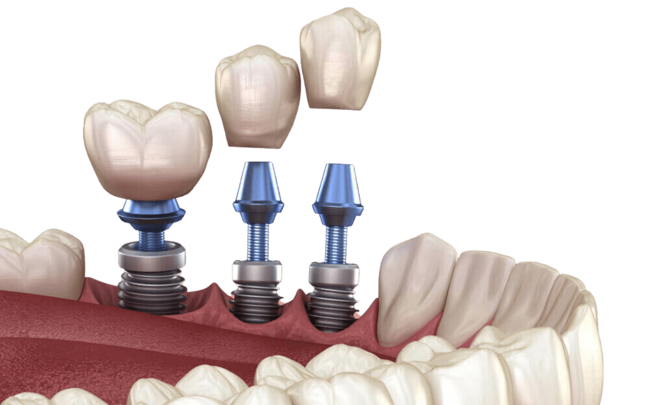Illustration of a dental implant, abutment, and crown planned as one replacement